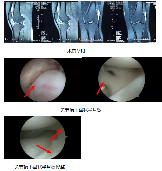 膝盖痛警惕盘状半月板损伤
