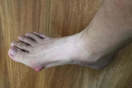 有这4个症状说明你痛风严重了,一定要注意!