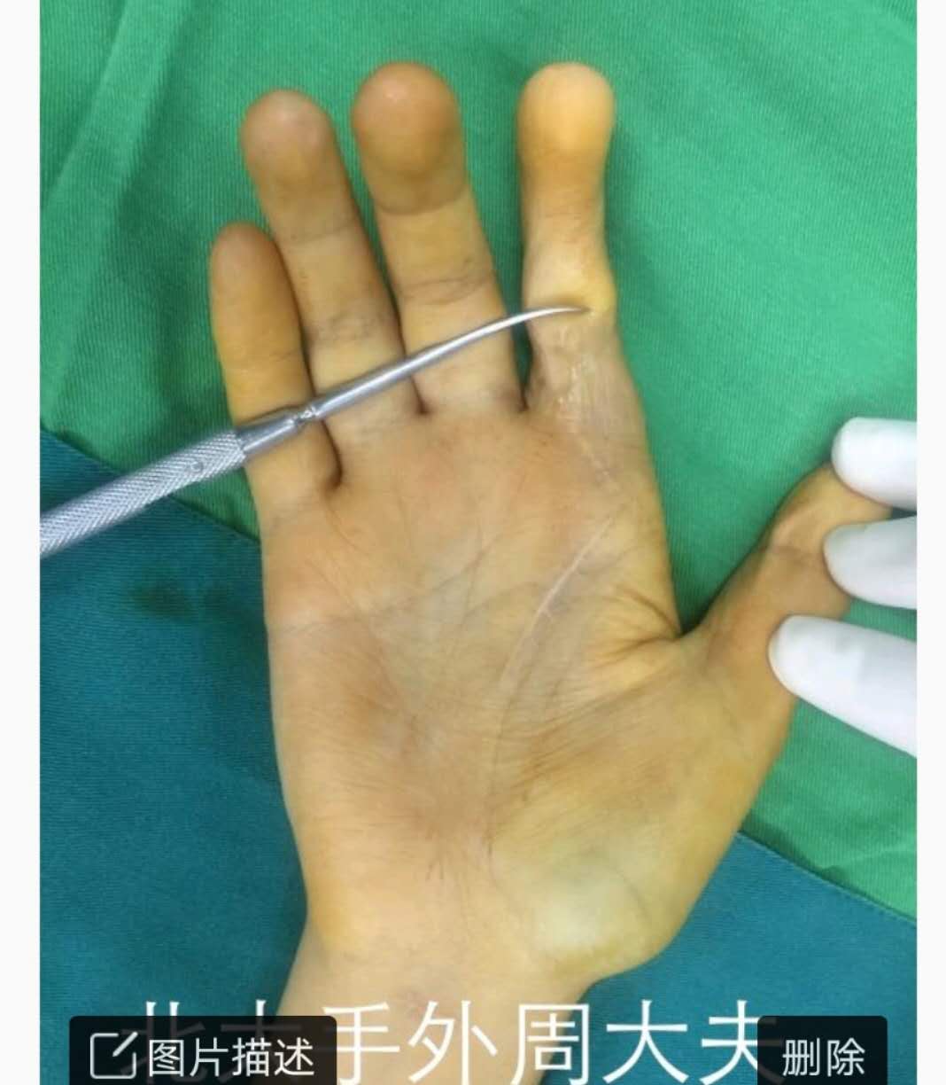 手指缺损的修饰性再造