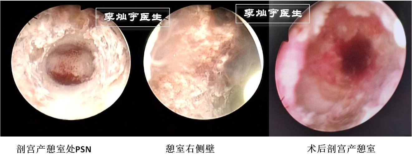 宫腔镜系列之(四)— 胎盘部位结节