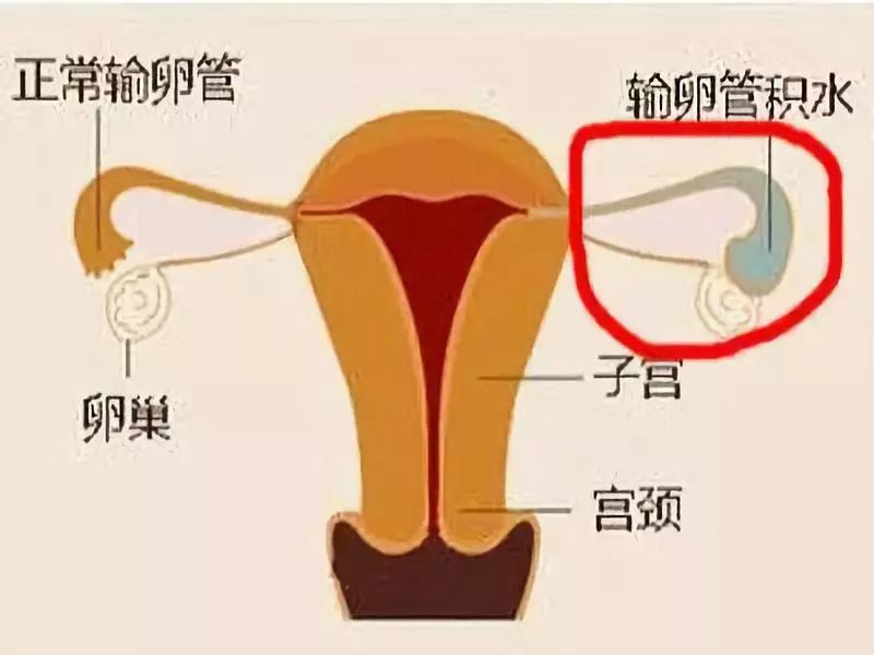 【孕育指南】输卵管积水手术后需要注意什么?
