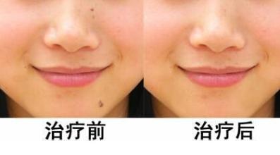 激光祛痣,点痣的详细解答,看完再也不害怕啦!