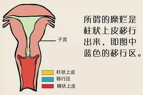 上面说到宫颈上皮有2种细胞,在这2种细胞的交界处,也就是宫颈鳞柱交界