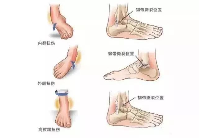 关节扭伤是非常常见的运动损伤,多数情况下是指足踝向内过度内翻旋转