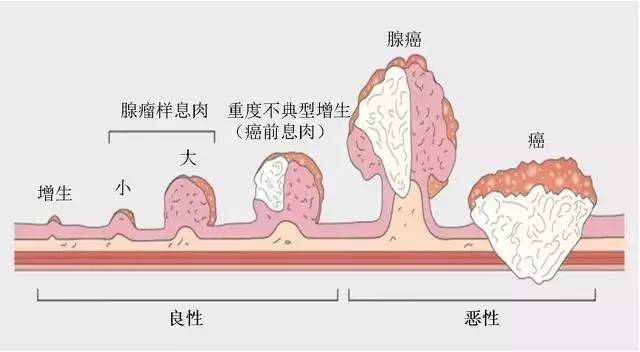 肠息肉癌变.jpeg