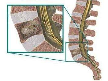 脊柱肿瘤的早期症状不明显,而且和其他常见的脊柱疾病症状非常类似