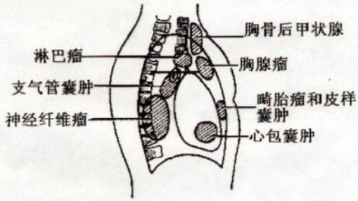 纵隔肿瘤是怎么回事?