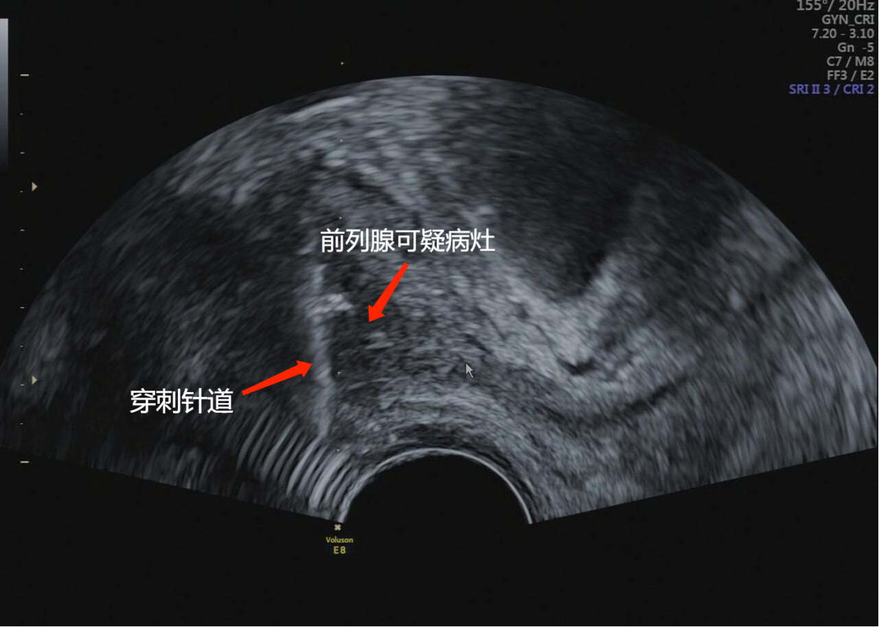 我科常规开展无痛经直肠超声引导下前列腺精准穿刺活检无痛化精准化