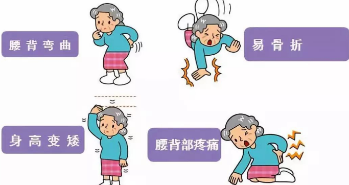 腰酸背痛腿抽筋警惕患上骨质疏松