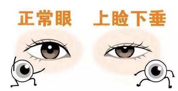 上睑下垂