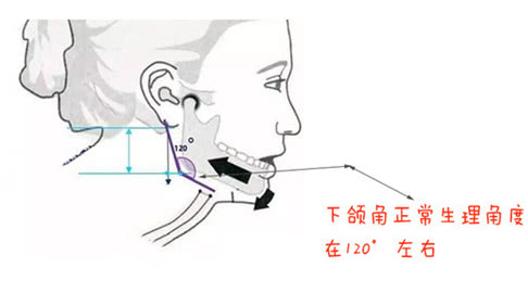 咬肌切除瘦脸一般维持多长时间?