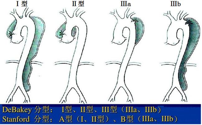 旋风杀手主动脉夹层是什么病