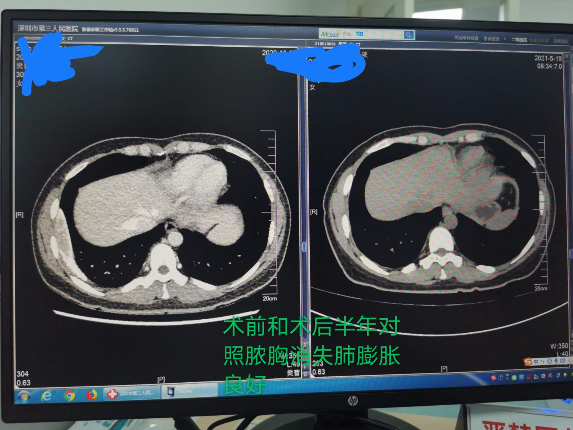 慢性局限性包裹性结核性脓胸是否需要外科手术干预