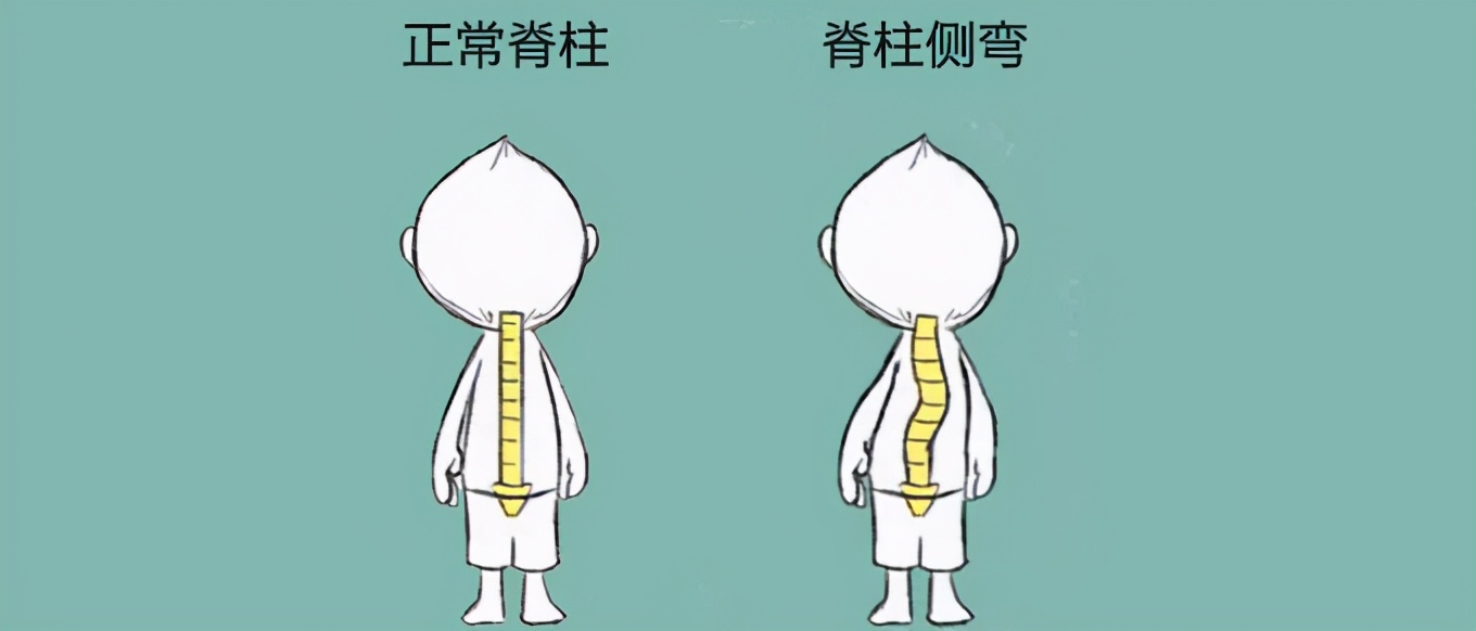 脊柱侧弯容易忽视的青少年常见病