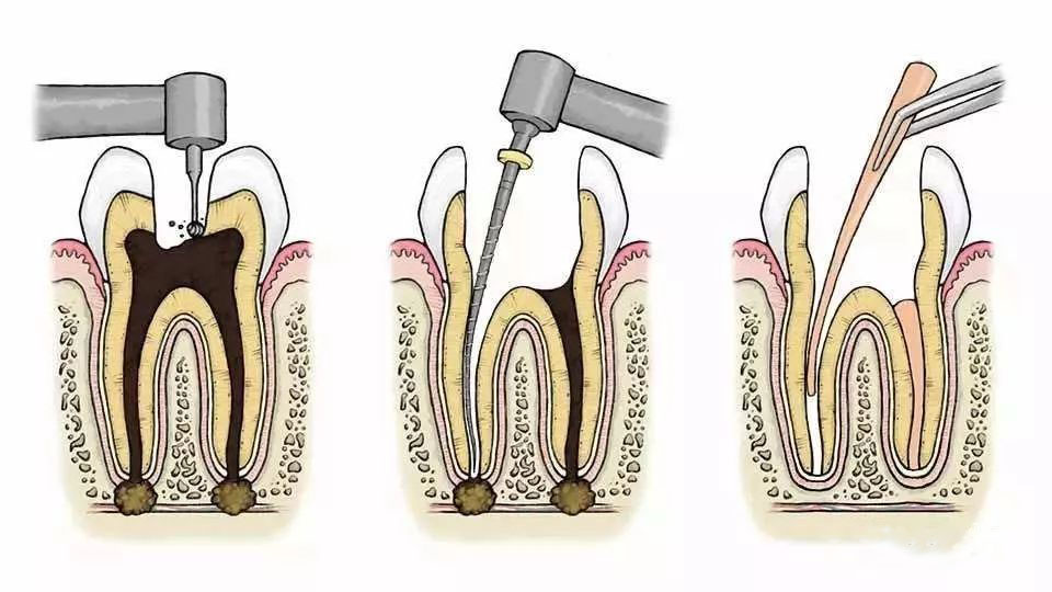 首先会清除根管内的炎症牙髓和坏死物质,接下来测量根管长度,并适当