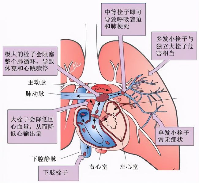 危及生命的胸痛急性肺动脉栓塞