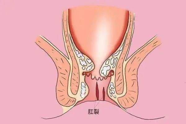 肛肠知识请问肛裂到什么程度要做手术