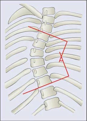 如履薄冰的重度脊柱侧弯手术脊柱截骨矫形术