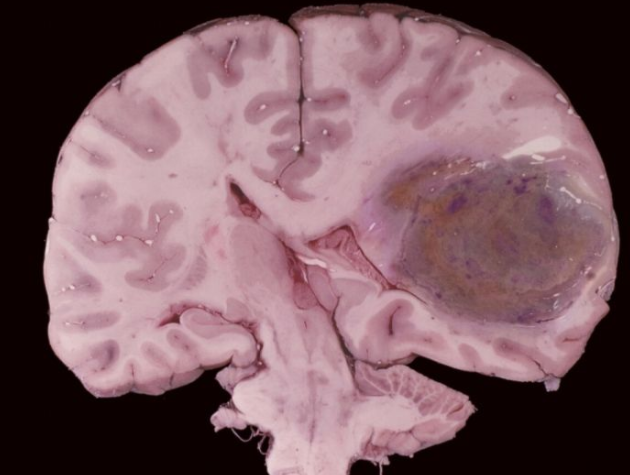 患脑肿瘤的早期症状表现有哪些呢?