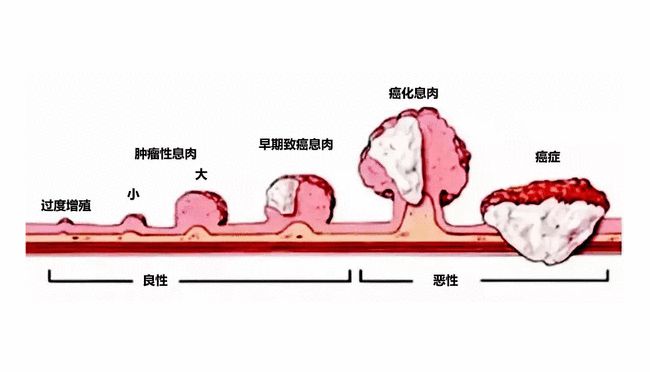 胃息肉往前一步是胃癌这4类胃息肉不容忽视