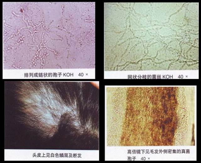 皮肤癣真菌感染怎么检查?