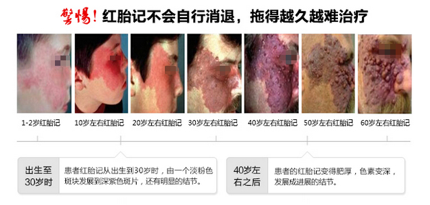 讲解红胎记危害触目惊心哪种治疗方法比较好