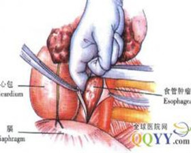 心胸肿瘤科-河南大学淮河医院-深圳就医160预