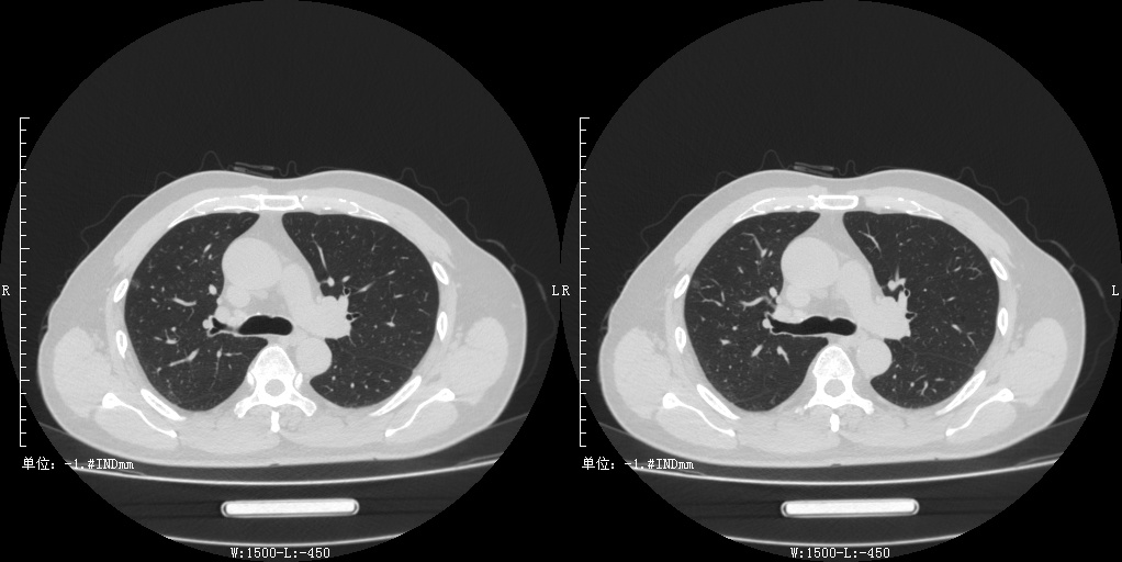 右肺上叶胸膜下可见微结节影,磨玻璃密度,ct 值-660 hu,3 年后复查无