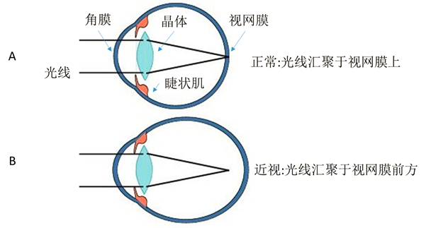 晶状体曲率变大或眼轴变长,导致光线聚焦在了视网膜前方,不能精准成像