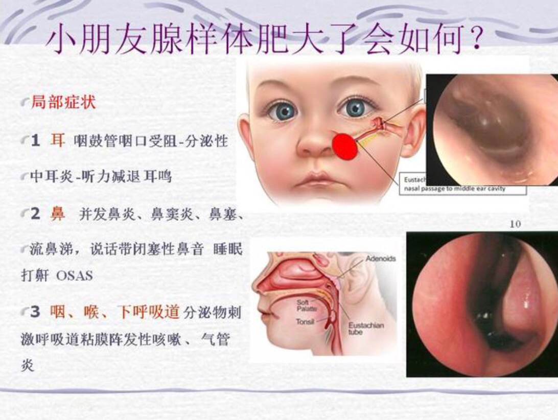 肥胖的扁桃体和腺样体到底有什么危害