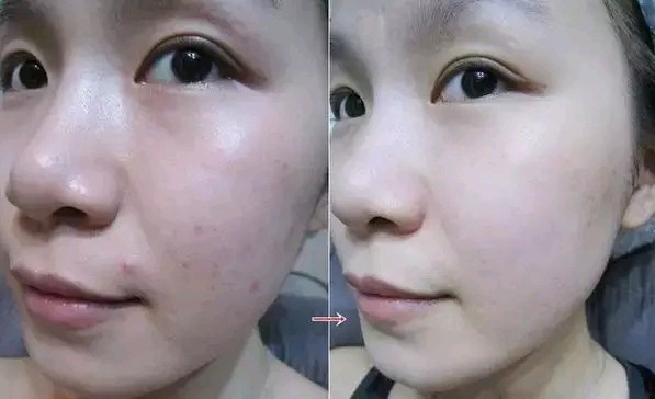 3.微针真人体验