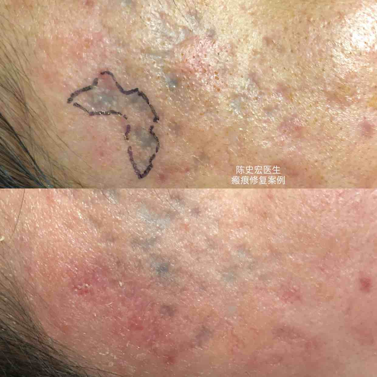 (分剥脱性和非剥脱性两种)4切除整形美容缝合5磨削手术健康160可以