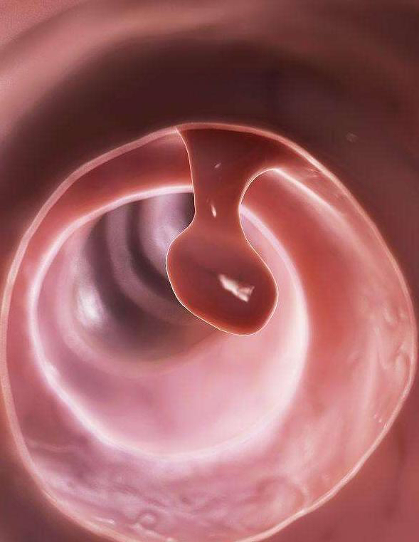 什么样的胃肠息肉才要割掉?