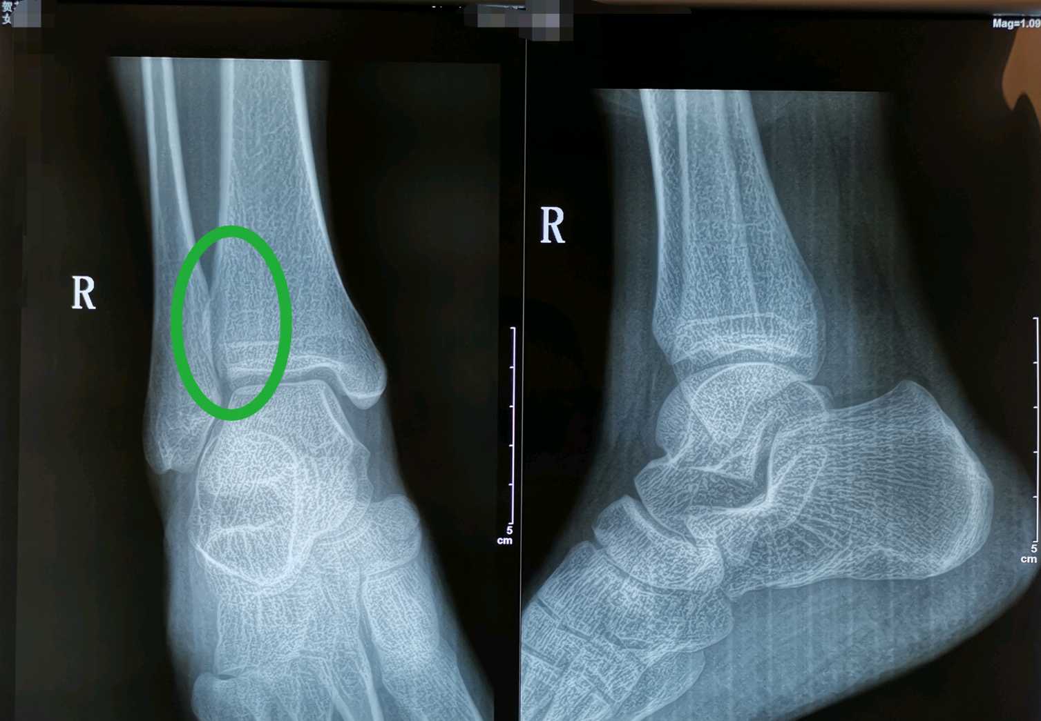 正常人右踝骨图片图片