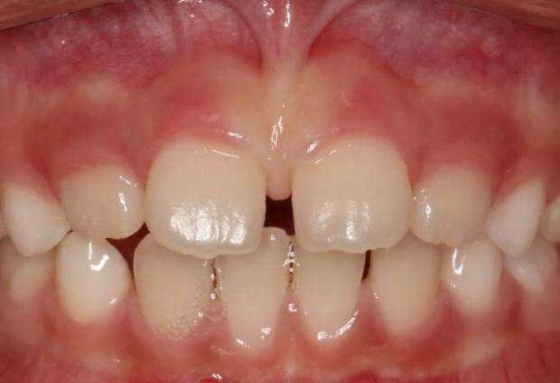 发现即矫正——12岁前必须处理的儿童牙颌畸形