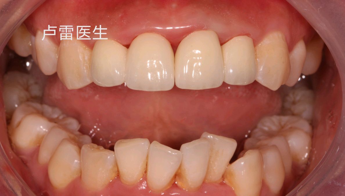 烤瓷牙拆除後全瓷牙重新修復前後對比