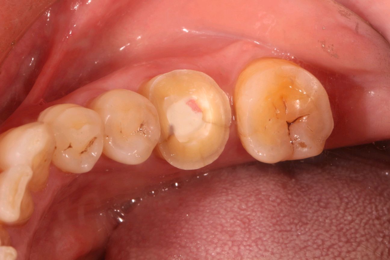 常见的牙体缺损及修复方法_广州德伦口腔