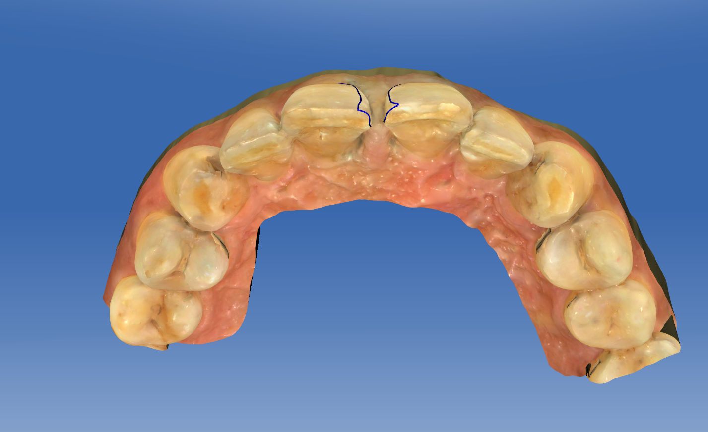 微贴面关闭上中切牙缝隙-健康160