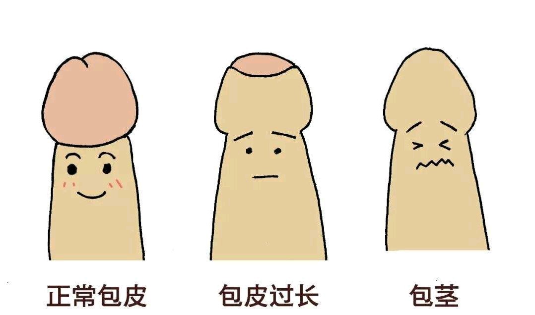 包茎是包皮口较小,上翻不能露出或部分露出尿道口和龟头.1313