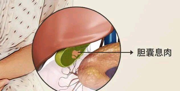 胆囊息肉长在哪里图片