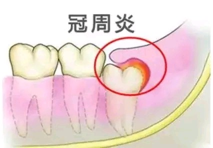 智齿疼真的该拔吗