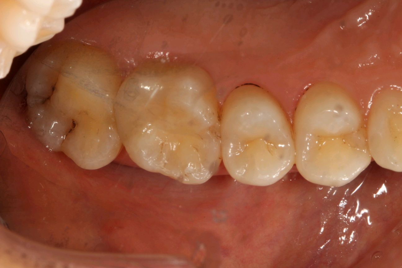 再治疗银汞合金补的牙，用树脂充填补牙。 - 知乎