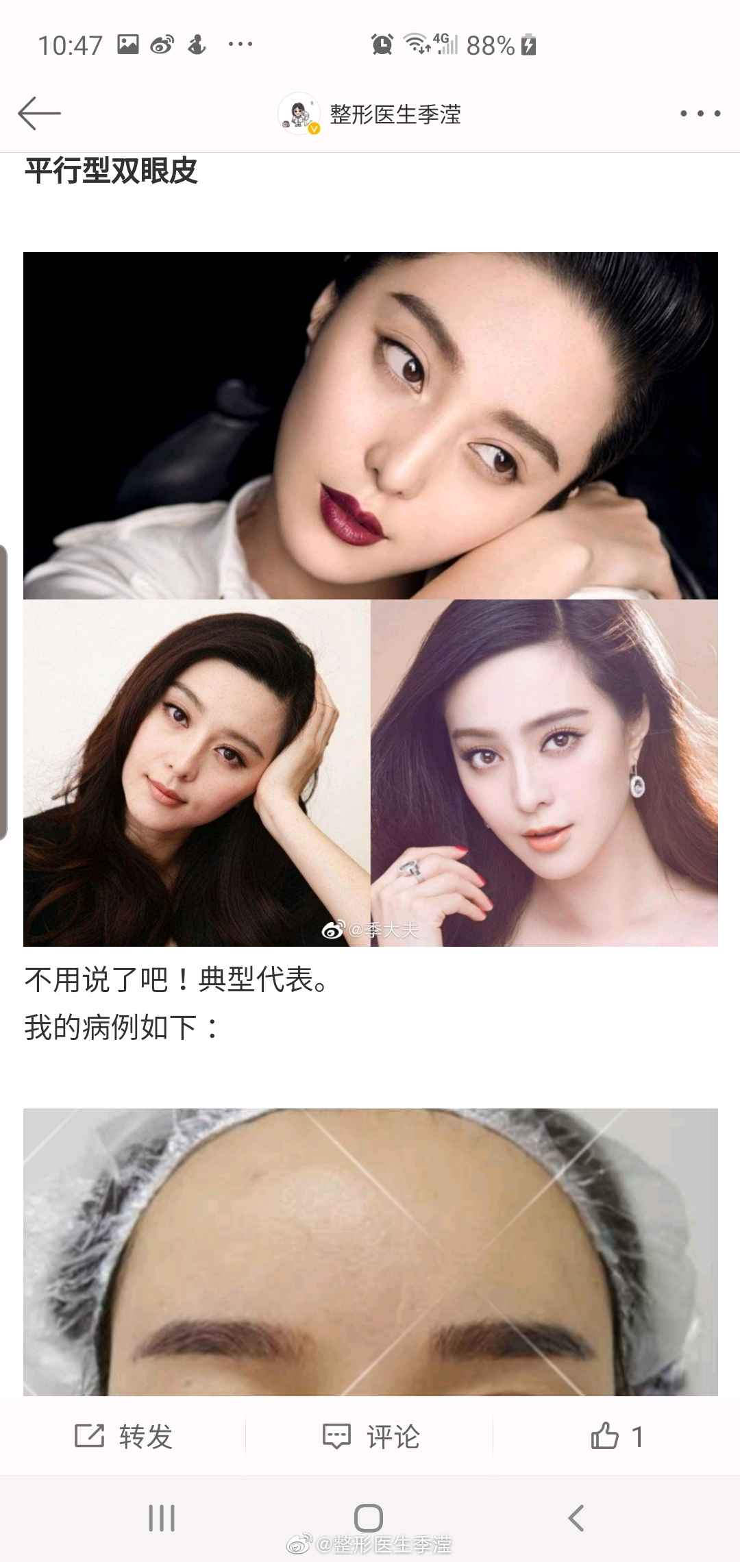 双眼皮开扇 平扇哪个好看 - 哔哩哔哩