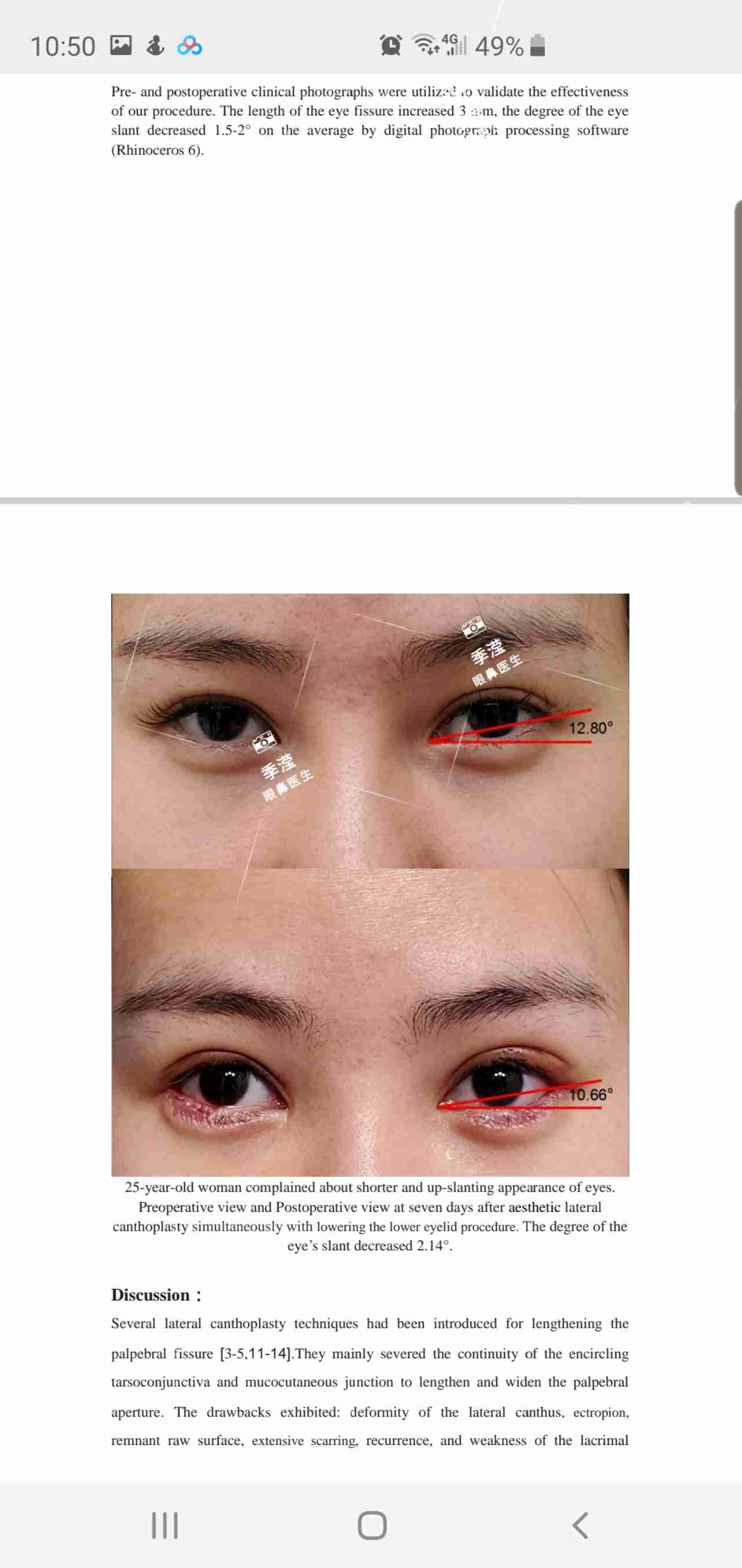 内眼角修复手术方式：V-Y推进皮瓣修复术 - 知乎