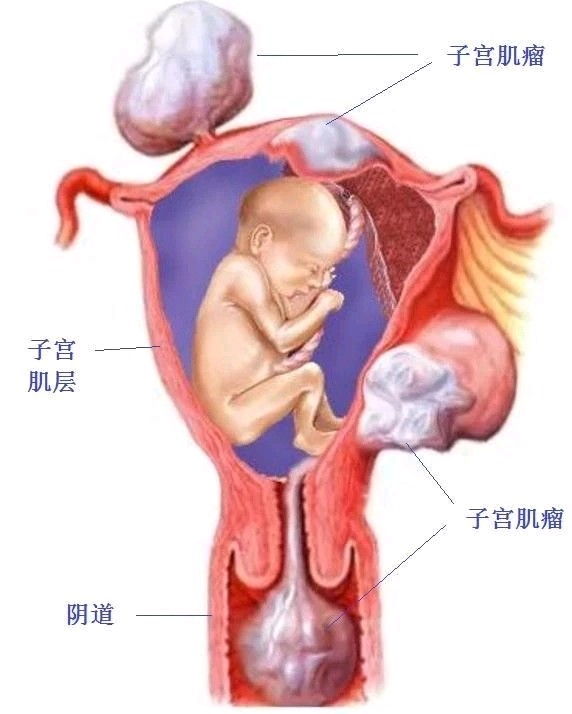 响受孕的。不过孕期要随诊子宫肌瘤大小，注意肌瘤红色变性发生。﻿﻿﻿