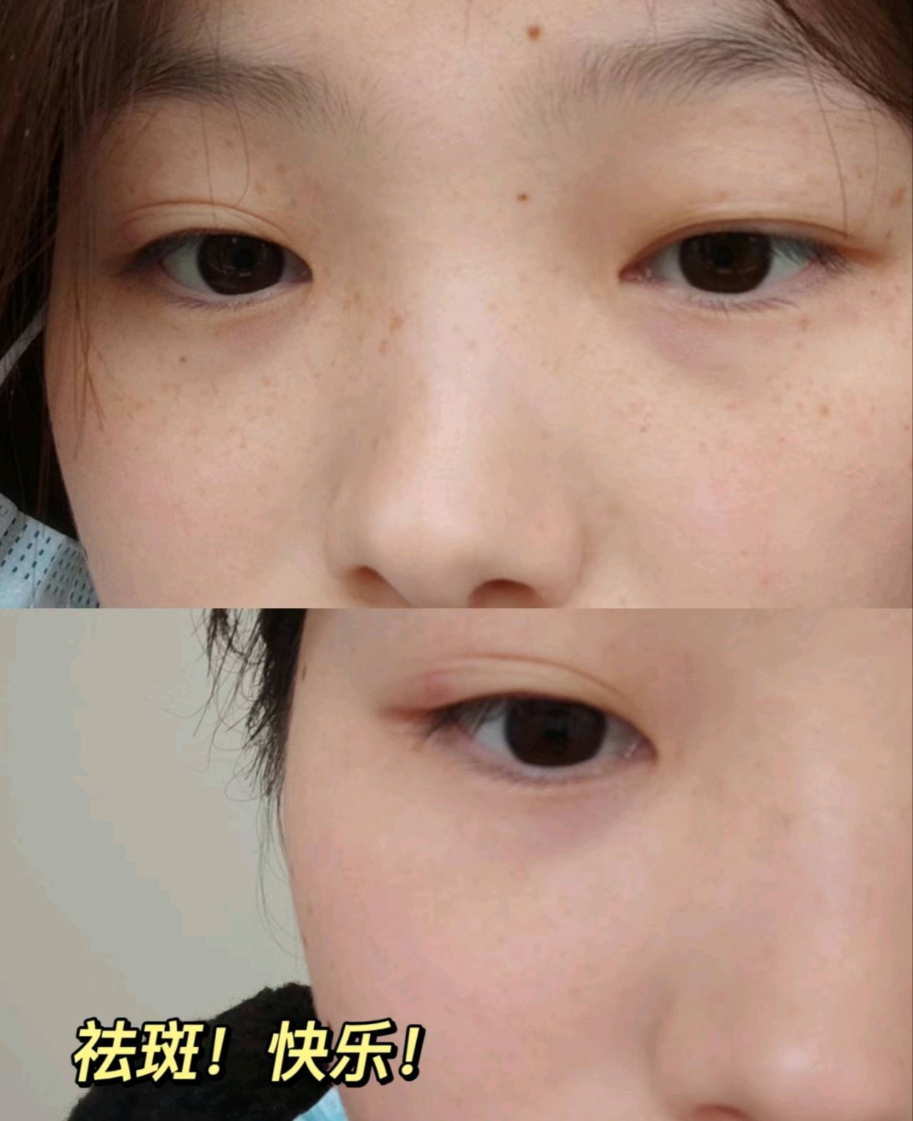 面部斑的种类图片 (9)_有来医生