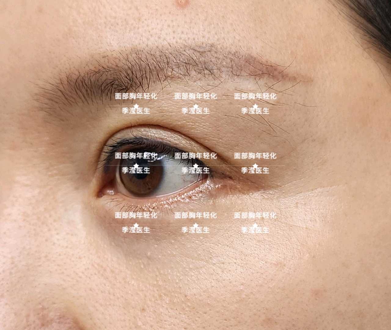 记录全切双眼皮+开眼角恢复过程 - 知乎