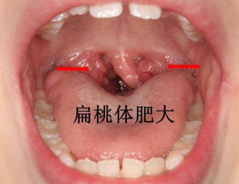 什么是扁桃体肥大健康160
