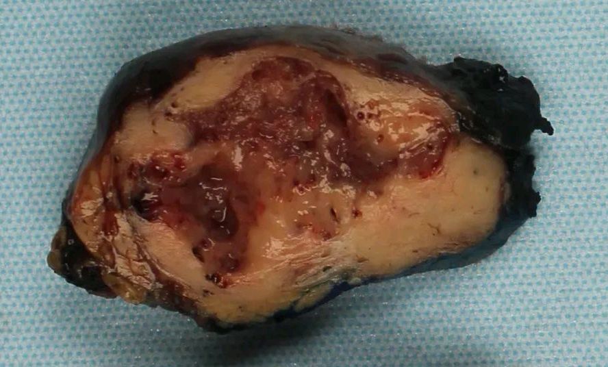 194、肝血管肉瘤严重吗？如何治疗？