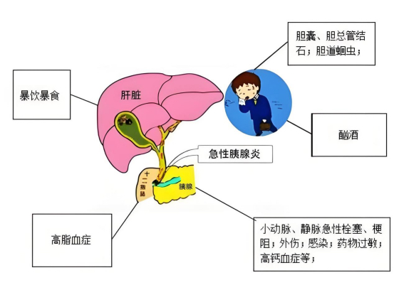 春节欢聚，警惕“油腻陷阱”﻿﻿﻿——高脂源性急性胰腺炎